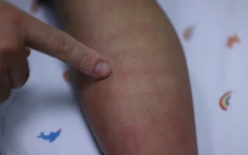 Sốt xuất huyết Dengue và những dự định dở dang bên giường bệnh