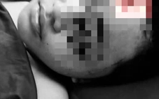 Thông tin thiếu niên 13 tuổi bị rạch mặt, cắt gân tay ở Huế là tin giả