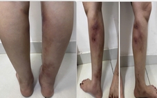 Chân biến dạng sau tiêm filler làm thẳng chân tại nhà