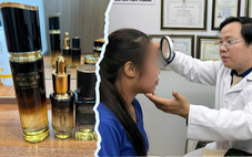 Cô gái trẻ viêm da, hỏng mặt vì dùng mỹ phẩm trôi nổi