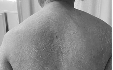 Tự ý bôi kem trộn, tắm lá, người phụ nữ bị nấm da lan khắp cơ thể