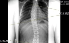 Chỉnh dáng cho trẻ vẹo cột sống bằng cách nào?