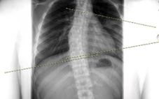 Chỉnh dáng cho trẻ vẹo cột sống bằng cách nào?