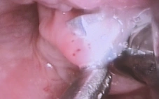 Cấp cứu bé trai nuốt phải nhiều viên nam châm