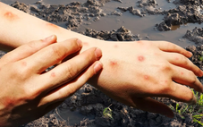 Thái Lan cảnh báo khẩn bệnh ‘sốt đất’, hơn 700 ca mắc, 23 người tử vong trong 4 tháng