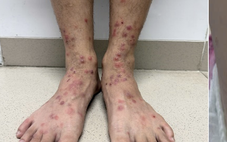 Bọ chét chó mèo ‘tấn công’ người, gây ngứa ngáy, viêm da vì điều trị sai cách