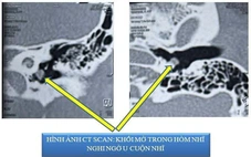 Bệnh nhân bị ù tai đến khám, bác sĩ bất ngờ phát hiện bệnh lạ