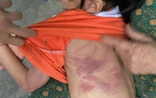 Bé gái lớp 2 bị bạn đánh bầm tím người trong giờ ra chơi