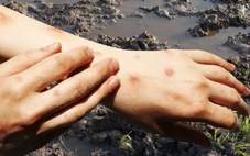 Bệnh ‘sốt đất ’ làm 23 người chết tại Thái Lan: Bộ Y tế cảnh báo, đưa ra các biện pháp phòng ngừa