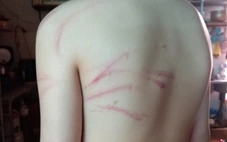 Vụ đi học thêm bị thầy đánh bầm tím: Tạm đình chỉ trung tâm dạy thêm