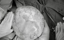 Hi hữu bé gái 14 tuổi mang khối u nặng hơn 4kg có răng, tóc, xương