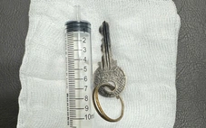 Bệnh nhi nuốt chìa khóa vào dạ dày, bác sĩ phải gây mê gắp ra ngoài