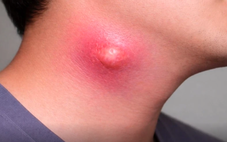 Đừng chủ quan với triệu chứng đau cổ, khó nuốt