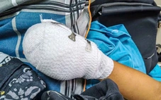 Bé trai bị dập nát bàn tay nghi do điện thoại phát nổ