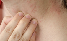 Ngứa kéo dài có thể là dấu hiệu cảnh báo sớm suy thận