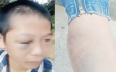 Công an xác minh vụ bé trai nghi bị đánh bầm tím