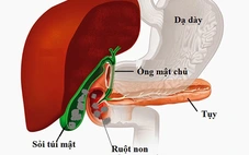 Ăn gì để ngăn ngừa bệnh sỏi mật?