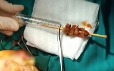 Chạy nhảy, bé gái bị que xiên thịt đâm sâu suýt xuyên sọ não