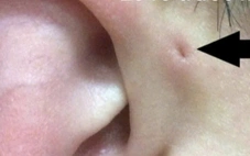Gia đình 3 thế hệ cùng mắc bệnh ít gặp rò luân nhĩ: Bệnh có nguy hiểm không?