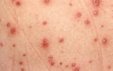 Vắc xin có từ lâu, vì sao ca nhập viện do thủy đậu vẫn tăng?