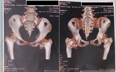 Bé gái 12 tuổi mắc hội chứng người hóa đá cực hiếm