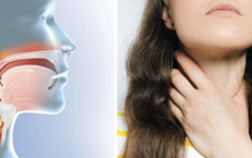 Triệu chứng ung thư vòm họng dễ nhầm với viêm họng, viêm xoang