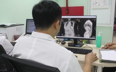 Bé trai 9 tuổi khó thở vì cột sống biến dạng sau 2 năm không tái khám