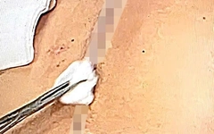 Chuyện kỳ lạ giữa lằn ranh sống - chết - Kỳ 9: 10 giờ chiến đấu với tử thần trên bàn mổ