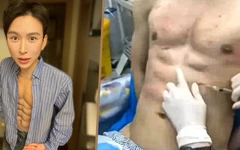 Chi 15 tỉ đồng để tiêm 10.000 liều axit tạo cơ bụng 8 múi