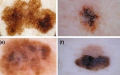 Đốm đen trên da, khi nào là dấu hiệu của ung thư da?