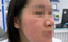 Hết trị bách bệnh, lại rước họa vì dùng nước cốt chanh trị mụn