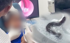 Gắp con đỉa trong đường thở của bệnh nhi 5 tuổi sau 1 tuần liên tục ho ra máu