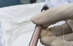 Thiếu nữ 16 tuổi phải cấp cứu ban đêm vì có cây bút trong bàng quang