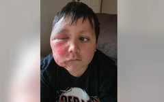 Bé trai bỏng nặng vì làm theo trào lưu TikTok cho đồ chơi vào lò vi sóng