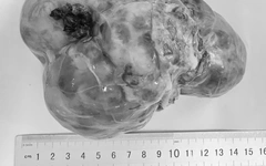 Liên tiếp trẻ mổ u ổ bụng, dấu hiệu ban đầu dễ nhầm với vấn đề tiêu hóa