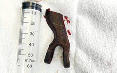 Kéo xe qua vũng lầy, tài xế bị dây xích đứt bắn thẳng vào mặt, xuyên qua hốc mắt