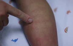 Sốt xuất huyết Dengue và những dự định dở dang bên giường bệnh