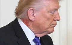 Bác sĩ Nhà Trắng lên tiếng về vết đỏ lạ trên cổ Tổng thống Trump