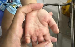 Báo động trẻ tử vong vì bệnh tay chân miệng tăng nhanh