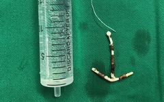 Lấy vòng tránh thai lạc chỗ suốt 1/4 thế kỷ