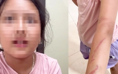 Xác minh vụ cháu bé bị bạo hành với 34 vết thương ở Đắk Lắk