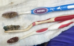 Nuốt 3 bàn chải đánh răng, nam bệnh nhân được cứu bằng nội soi