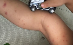 TP.HCM: Hơn 1.300 ca tay chân miệng trong một tuần, cao hơn ngưỡng cảnh báo