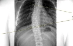 Chỉnh dáng cho trẻ vẹo cột sống bằng cách nào?