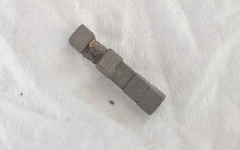 Cấp cứu bé trai nuốt phải nhiều viên nam châm