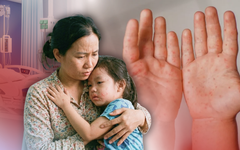 Ca bệnh tay chân miệng nặng đã tăng gấp 5 lần, hướng dẫn cha mẹ cách phòng tránh bệnh cho con