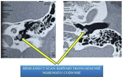 Bệnh nhân bị ù tai đến khám, bác sĩ bất ngờ phát hiện bệnh lạ