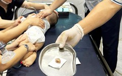 Bé trai 16 tháng tuổi tím tái, suy hô hấp vì hóc hạt chôm chôm