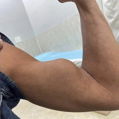 Đứt gân con chuột - chấn thương dễ gặp nhưng ít người để ý khi chơi thể thao