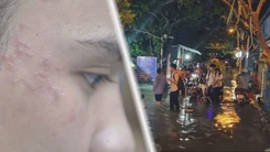 Góc nhìn trưa nay: Đề phòng bệnh viêm da do kiến ba khoang; TP.HCM và ĐBSCL bị ngập sâu, vì sao?